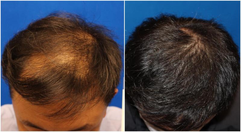 年輕的地中海植發(fā),如何完成自身的升華,找回青春的自信